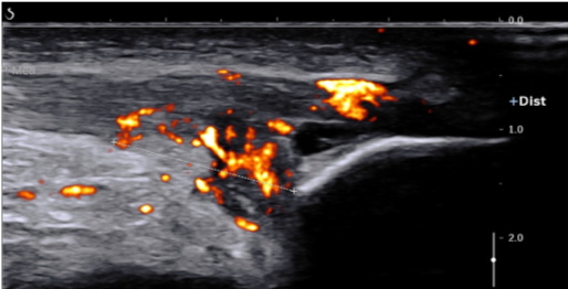 Top 10 reasons for using ultrasound in MSK & Sports Medicine