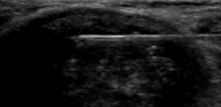 Ultrasound Guided Injections of the Shoulder Girdle