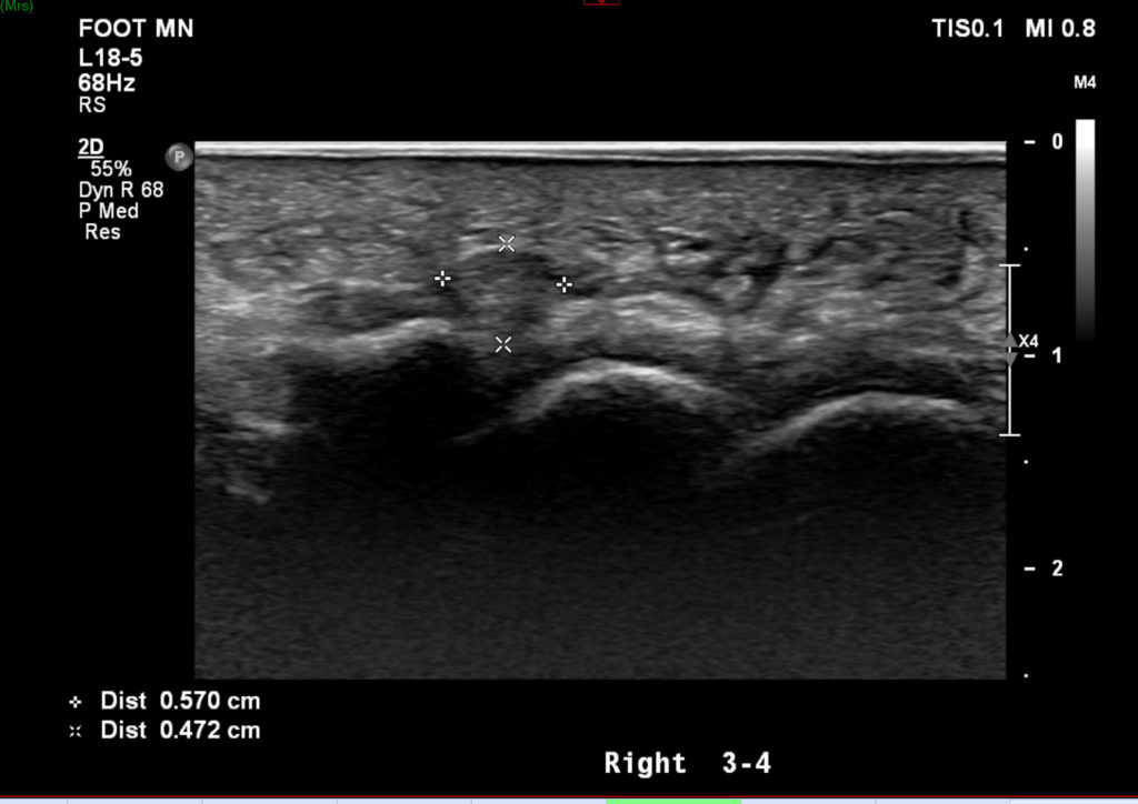 Case Study Clinical Application of Sonography in Diagnosis and Management of Morton’s Neuroma