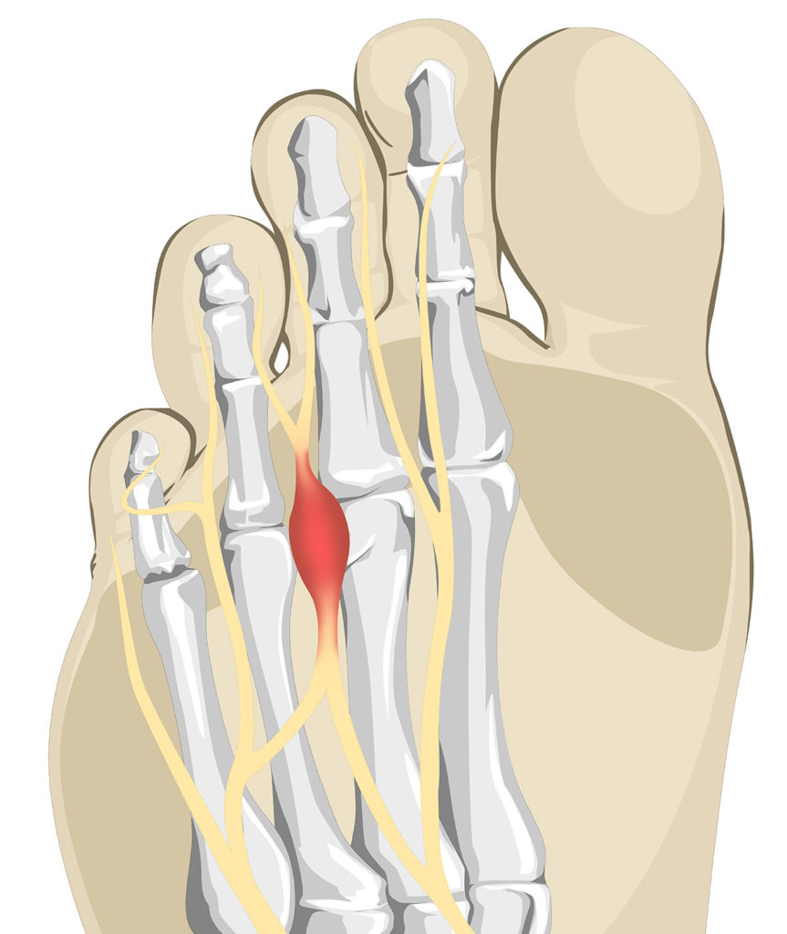 Case Study - Clinical Application of Sonography in Diagnosis and Management of Morton’s Neuroma